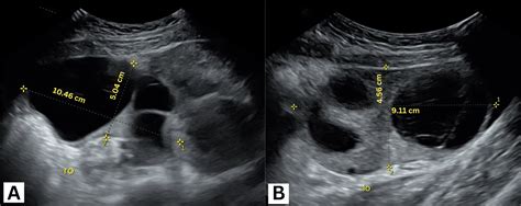 diagnostic test for ovarian torsion|ovarian torsion recovery time.